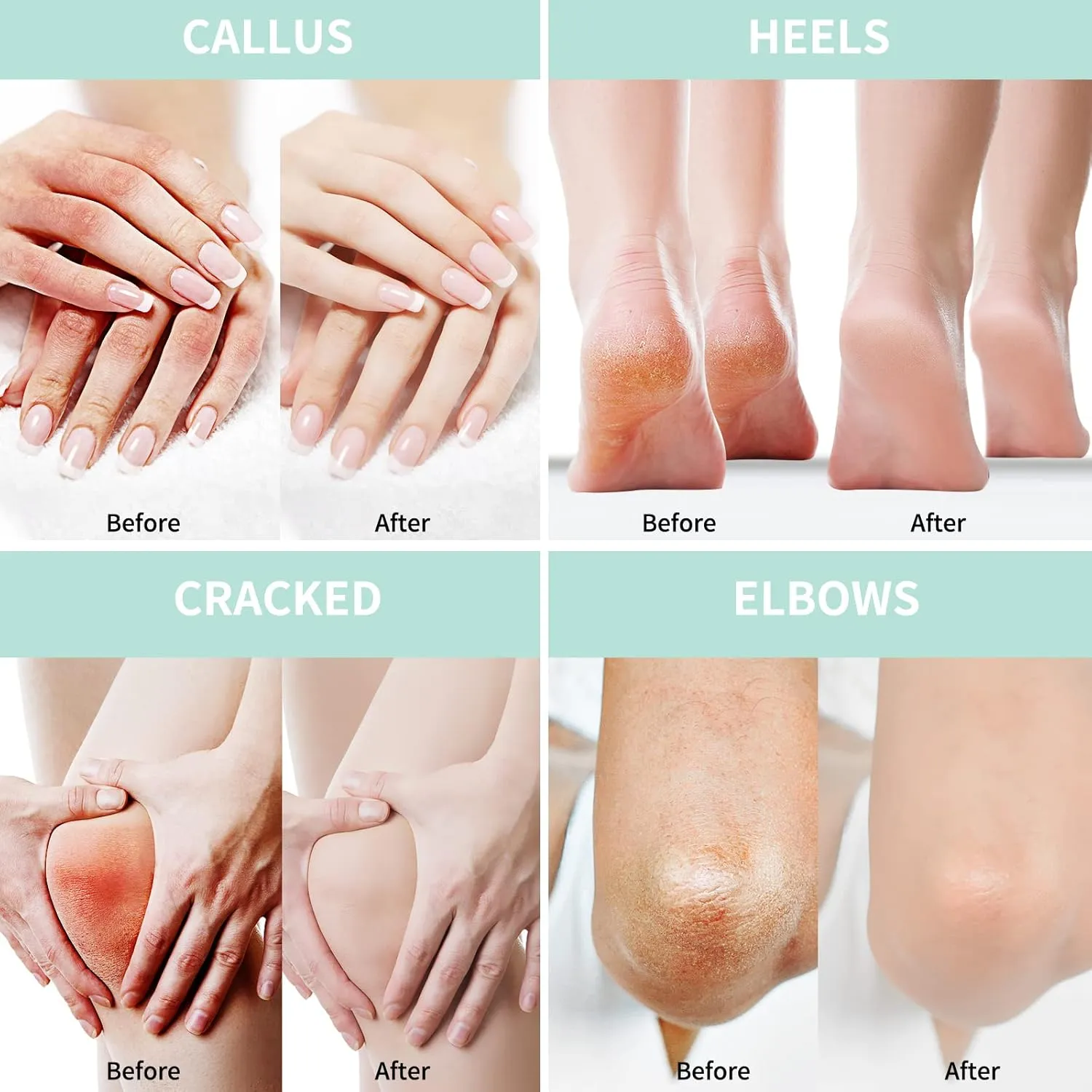 2 Packs Urea Cream 20% Plus 2% Salicylic Acid 5.3oz || Foot Cream Maximum Strength with Hyaluronic Acid, Tea Tree and Aloe Vera for Deep Moisturizes, Callus Remover and Soften